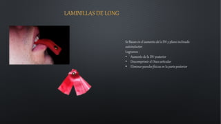 LAMINILLAS DE LONG
Se Basan en el aumento de la DV y plano inclinado
autoinductor.
Logramos :
• Aumento de la DV posterior
• Descomprimir el Disco articular
• Eliminar paredes físicas en la parte posterior
 