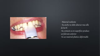 - Material resiliente
- Su ancho no debe abarcar mas allá
de los IC
-Su contacto es en superficie produce
un fulcrum anterior
-Es un material plástico deformable
 