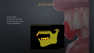 JIG DE LUCIA
- Un tope artificial
- Es de acrílico de autocurado
- No sobrepasa el grupo incisivo
- No llega a tejidos blandos
 