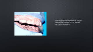 Dejar aproximadamente 2 mm
de separacion a la altura de
los 2dos molarees
 