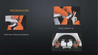 PROGRAMACIÓN
TRAYECTORIA CONDÍLEA 30ª (PROMEDIAL)
ANGULO DE BENNETT 15°
 