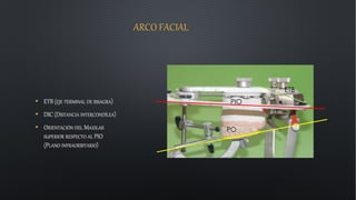 ARCO FACIAL
ETB
PIO
PO
• ETB (EJE TERMINAL DE BISAGRA)
• DIC (DISTANCIA INTERCONDÍLEA)
• ORIENTACIÓN DEL MAXILAR
SUPERIOR RESPECTO AL PIO
(PLANO INFRAORBITARIO)
 