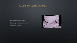 CAUSAS PARA UN REMONTAJE
• MAL CHEQUEO DEL ARTICULADOR
• MODELOS QUE NO REPRODUCEN LA BOCA
• REGISTRO MAL TOMADO
 