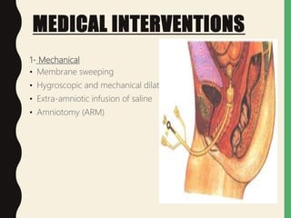 Arm Induction Induction of-labour | PPTX