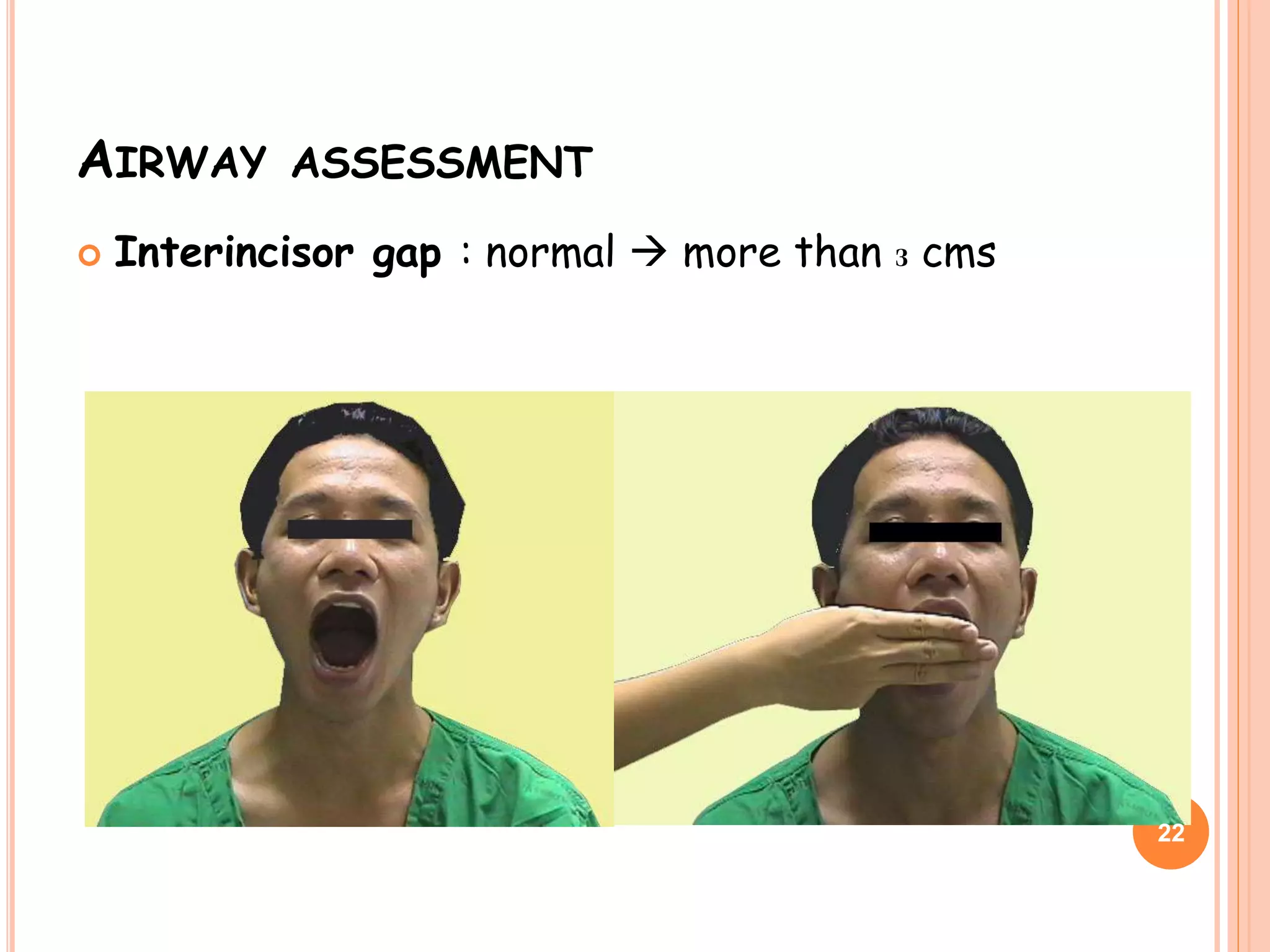 AIRWAY ASSESSMENT
 Interincisor gap : normal  more than 3 cms
22
 