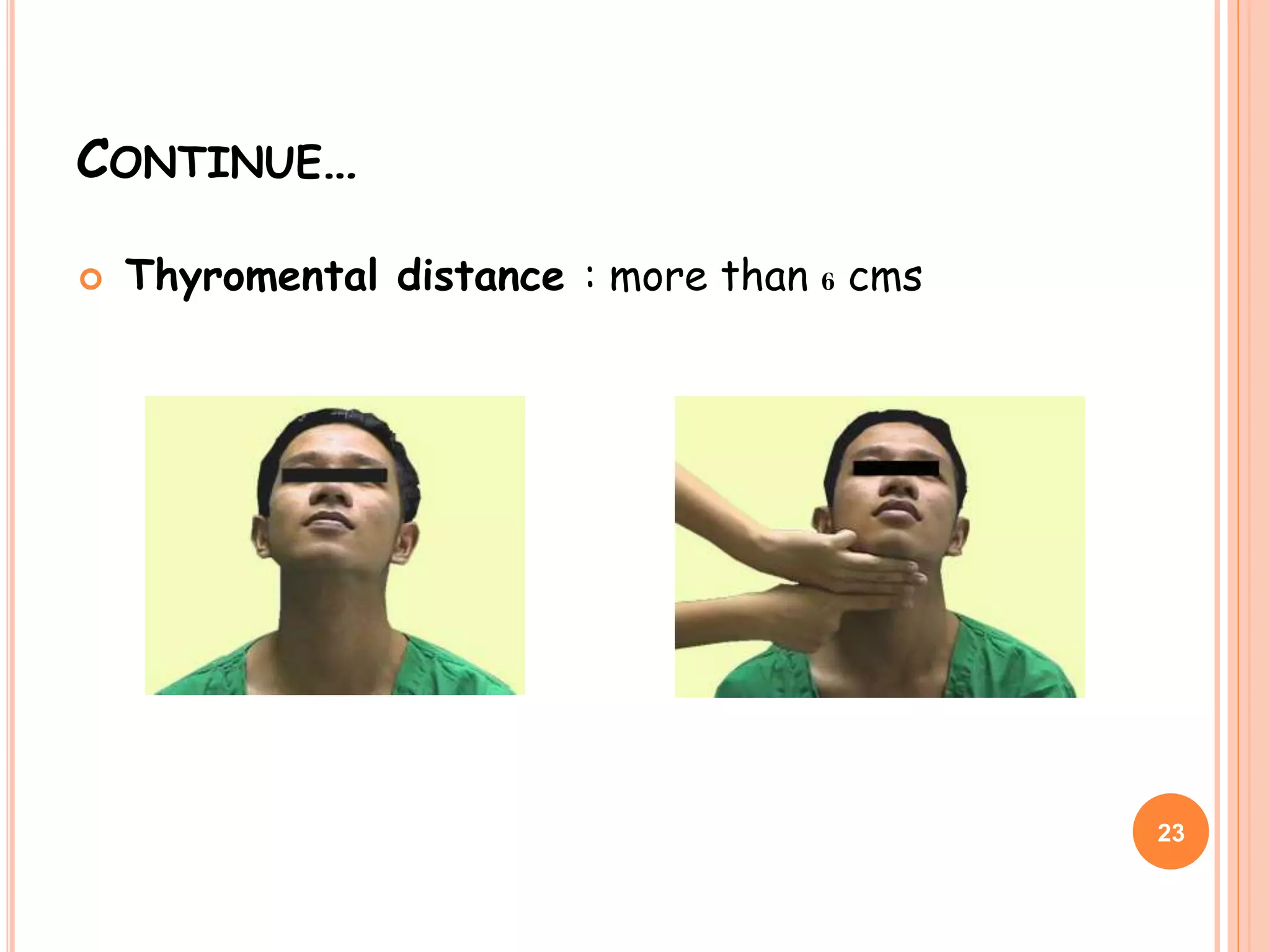 CONTINUE…
 Thyromental distance : more than 6 cms
23
 