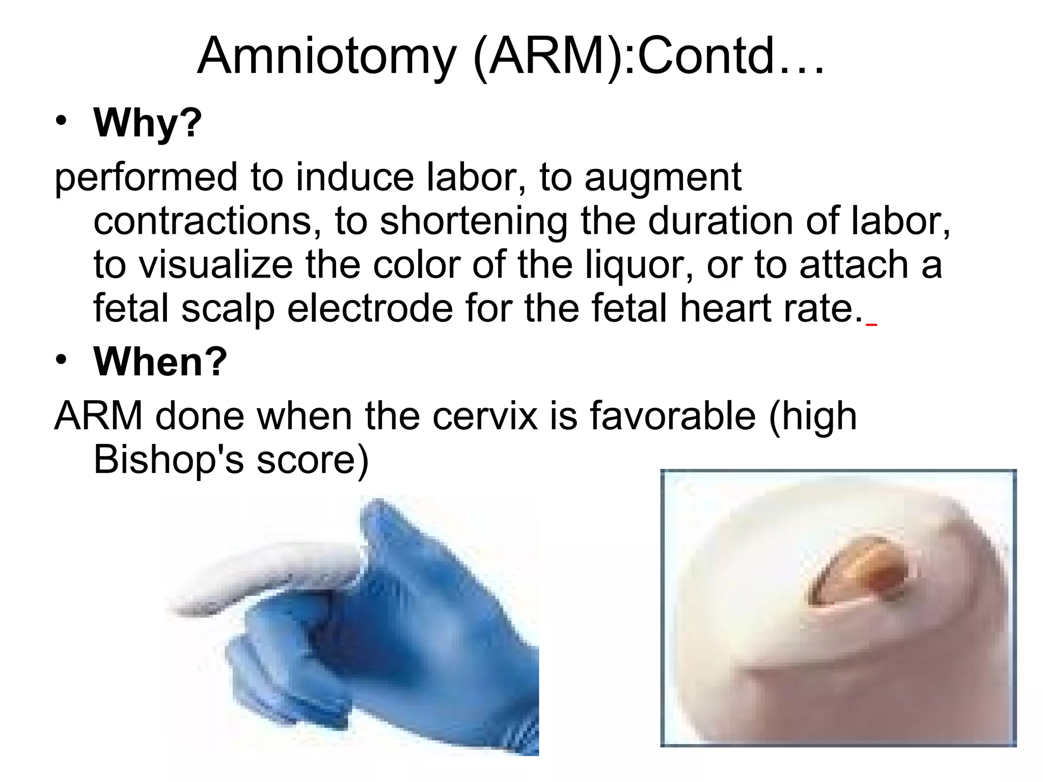 Amniotomy (ARM):Contd…
• Why?
performed to induce labor, to augment
contractions, to shortening the duration of labor,
to visualize the color of the liquor, or to attach a
fetal scalp electrode for the fetal heart rate.
• When?
ARM done when the cervix is favorable (high
Bishop's score)

 