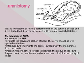 Arm Induction Induction of labour | PPTX