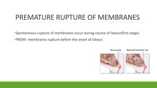 Arm Induction Induction of labour | PPTX