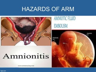 Arm Induction Induction of labour | PPTX