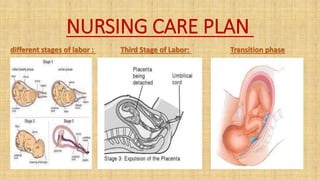 NURSING CARE PLAN
different stages of labor : Third Stage of Labor: Transition phase
 