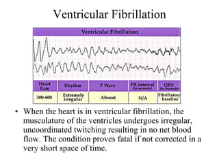 Ventricular Fibrillation
• When the heart is in ventricular fibrillation, the
musculature of the ventricles undergoes irregular,
uncoordinated twitching resulting in no net blood
flow. The condition proves fatal if not corrected in a
very short space of time.
 