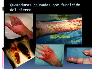 Quemaduras causadas por fundición
del hierro
 