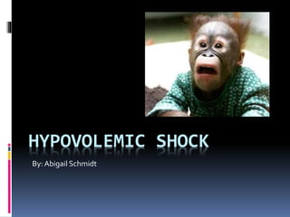 HYPOVOLEMIC SHOCK
By: Abigail Schmidt
 