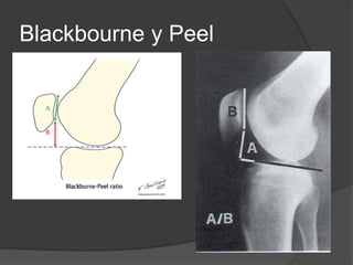 Blackbourne y Peel 
 