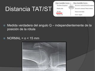 Distancia TAT/ST 
 Medida verdadera del angulo Q – independientemente de la 
posición de la rótula 
 NORMAL = o < 15 mm 
 