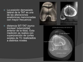  La posición demasiado 
lateral de la TAT es una 
de las alteraciones 
anatómicas mencionadas 
con mayor frecuencia 
 distancia SIT-TAT (surco 
troclear/ tuberosidad 
anterior de la tibia). Esta 
medición se realiza con 
superposición de cortes 
axiales de TC realizados 
a distintos niveles 
 