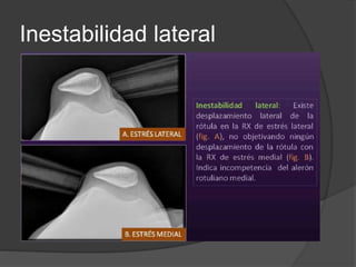 Inestabilidad lateral 
 