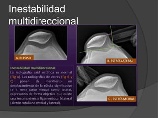 Inestabilidad 
multidireccional 
 