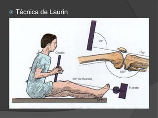  Técnica de Laurin 
 