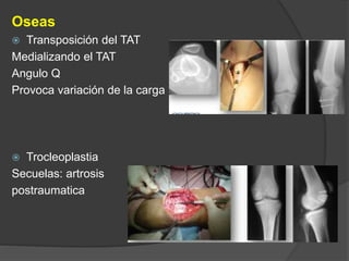 Oseas 
 Transposición del TAT 
Medializando el TAT 
Angulo Q 
Provoca variación de la carga 
 Trocleoplastia 
Secuelas: artrosis 
postraumatica 
 