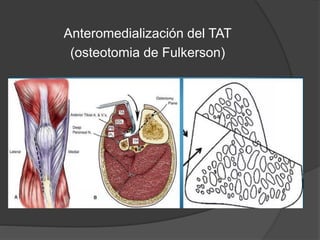 Anteromedialización del TAT 
(osteotomia de Fulkerson) 
 