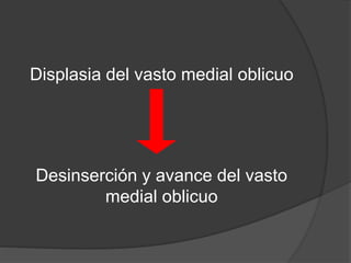 Displasia del vasto medial oblicuo 
Desinserción y avance del vasto 
medial oblicuo 
 