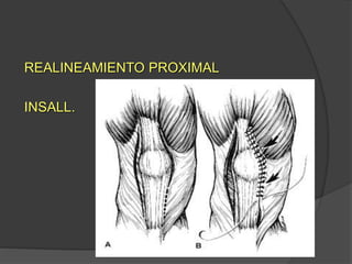 REALINEAMIENTO PROXIMAL 
INSALL. 
 