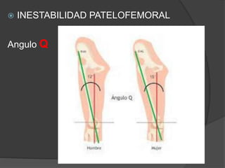  INESTABILIDAD PATELOFEMORAL 
Angulo Q 
 