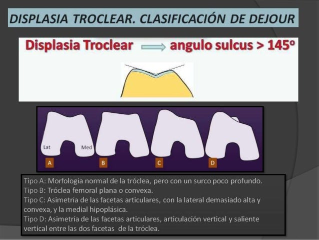 Inestabilidad Patelofemoral inestabilidad-patelofemoral