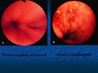 Normal esophageal mucosa erosive esophagitis 