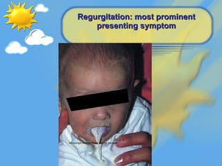 Regurgitation: most prominent presenting symptom ©Copyright Science Press Internet Services 