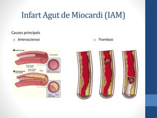 Infart Agut de Miocardi (IAM)
Causes principals
o Trombosio Arterosclerosi
 