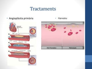 Tractaments
• Angioplàstia primària • Fibrinòlisi
 