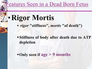 •Rigor Mortis
 rigor "stiffness", mortis "of death")
Stiffness of body after death due to ATP
depletion
Only seen if age > 9 months
 