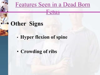 • Other Signs
• Hyper flexion of spine
• Crowding of ribs
 
