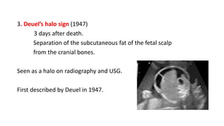 3. Deuel’s halo sign (1947)
3 days after death.
Separation of the subcutaneous fat of the fetal scalp
from the cranial bones.
Seen as a halo on radiography and USG.
First described by Deuel in 1947.
 