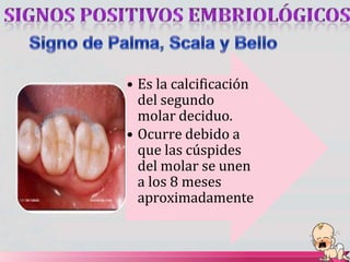 • Es la calcificación
del segundo
molar deciduo.
• Ocurre debido a
que las cúspides
del molar se unen
a los 8 meses
aproximadamente
 