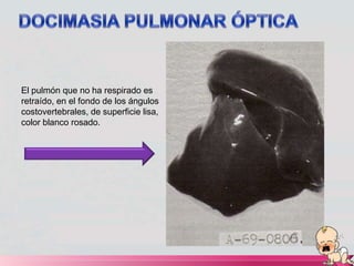 El pulmón que no ha respirado es
retraído, en el fondo de los ángulos
costovertebrales, de superficie lisa,
color blanco rosado.
 