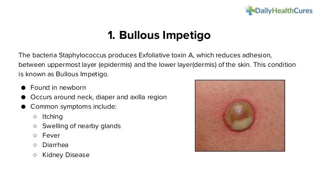 What Is Infantigo : Is Impetigo Contagious? How Does It Spread? – KRESI