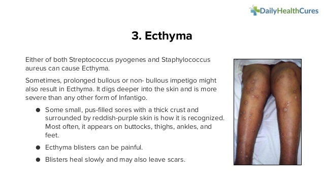 Invatago Infantigo: Types, Causes, Contagious, Symptoms, And Treatments – HCRCTM