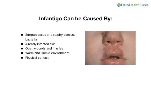 Can Infantigo Cause Scab? , Impetigo Pictures, Symptoms, and Treatment ...