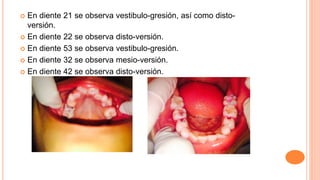  En diente 21 se observa vestibulo-gresión, así como disto-
versión.
 En diente 22 se observa disto-versión.
 En diente 53 se observa vestibulo-gresión.
 En diente 32 se observa mesio-versión.
 En diente 42 se observa disto-versión.
 