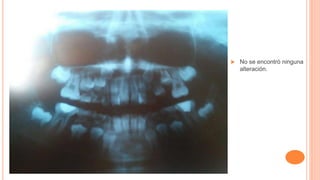  No se encontró ninguna
alteración.
 