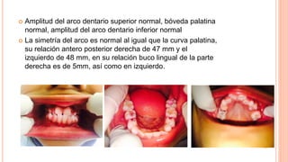  Amplitud del arco dentario superior normal, bóveda palatina
normal, amplitud del arco dentario inferior normal
 La simetría del arco es normal al igual que la curva palatina,
su relación antero posterior derecha de 47 mm y el
izquierdo de 48 mm, en su relación buco lingual de la parte
derecha es de 5mm, así como en izquierdo.
 