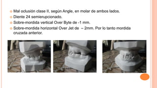  Mal oclusión clase II, según Angle, en molar de ambos lados.
 Diente 24 semierupcionado.
 Sobre-mordida vertical Over Byte de -1 mm.
 Sobre-mordida horizontal Over Jet de – 2mm. Por lo tanto mordida
cruzada anterior.
 