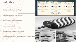 Fixation Preference Testing Infantile esotropia | PPTX