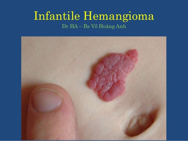 Infantile Hemangioma
Dr HA – Bs Võ Hoàng Anh
 