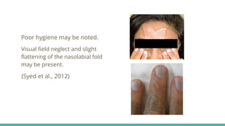 Poor hygiene may be noted.
Visual field neglect and slight
flattening of the nasolabial fold
may be present.
(Syed et al., 2012)
 