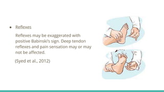 ● Reflexes
Reflexes may be exaggerated with
positive Babinski’s sign. Deep tendon
reflexes and pain sensation may or may
not be affected.
(Syed et al., 2012)
 